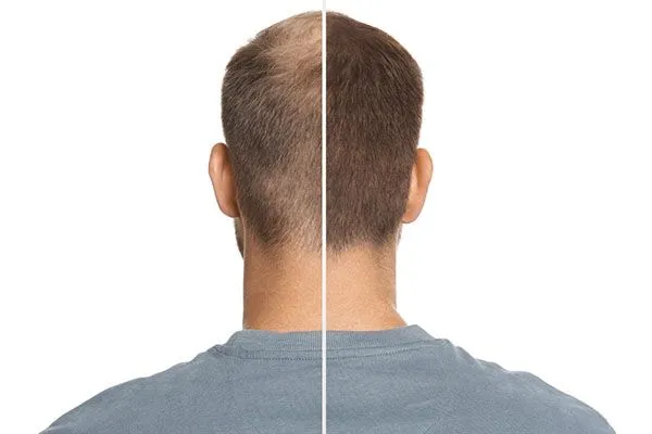 Greffe de cheveux: questions fréquemment posées