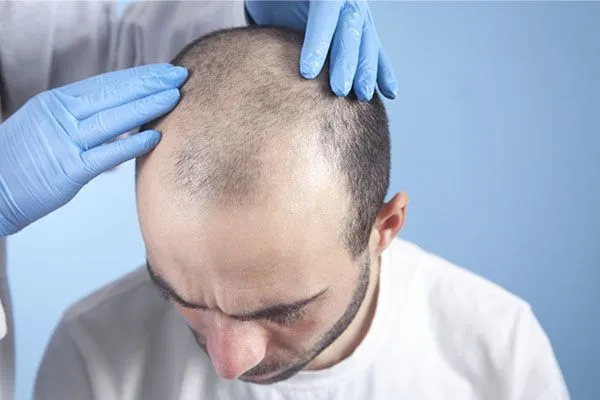 Greffe de cheveux: questions fréquemment posées