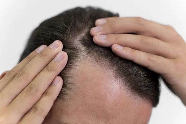 Chute de cheveux avec racines blanches : normal ou inquiétant ?