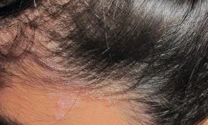 Dermatite seborroica e caduta dei capelli