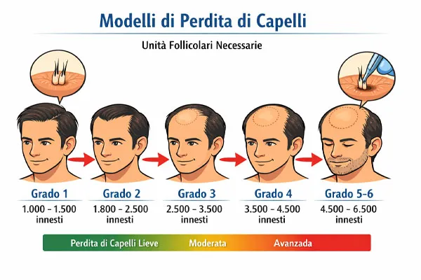 Trapianto di capelli: numero di unità follicolari per area da coprire 5 Trapianto di capelli: numero di unità follicolari per area da coprire