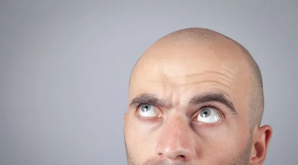 Pazienti che non sono idonei per un trapianto di capelli