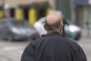 Guida completa agli esami per diagnosticare l’alopecia 2 Guida completa agli esami per diagnosticare l’alopecia