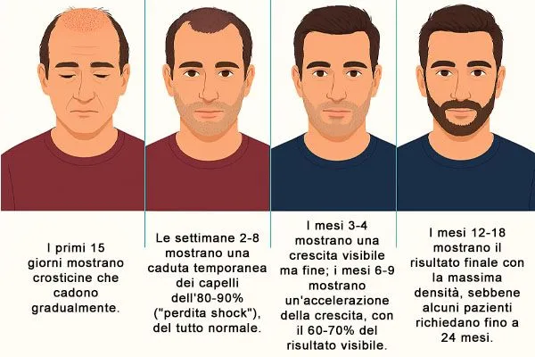 Esperienze Reali di Trapianto Capelli: Testimonianze, Risultati e Storie di Successo