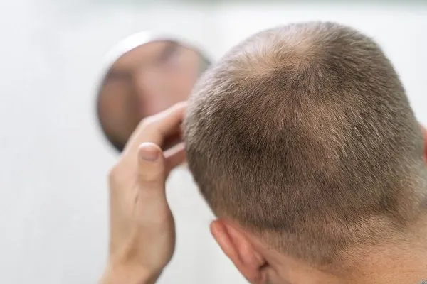 Come fermare l’alopecia?