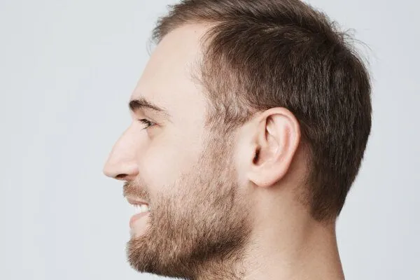 Si può fermare l’alopecia giovanile? 4 Si può fermare l’alopecia giovanile?