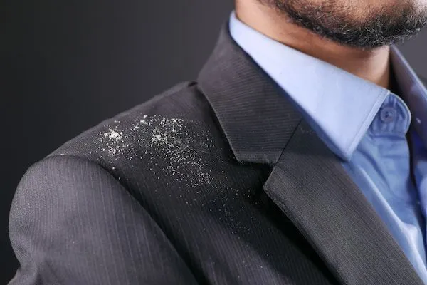 Come trattare la forfora negli uomini