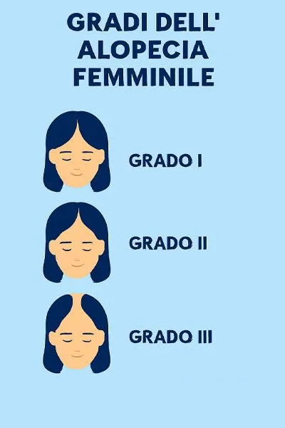 Gradi di alopecia