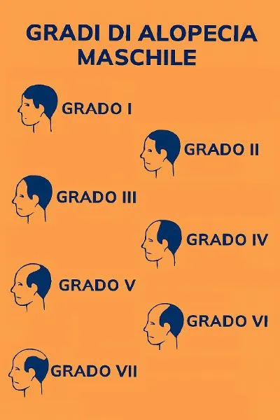 Gradi di alopecia