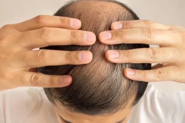 Greffe de cheveux: questions fréquemment posées