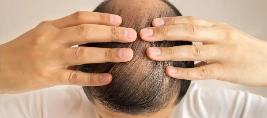 Greffe de cheveux: questions fréquemment posées