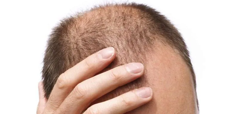 Greffe de cheveux chez les célébrités : mythes, réalités et enseignements pour le grand public