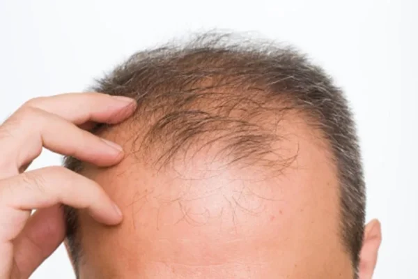 Greffe de Cheveux : Le Guide Complet 2026