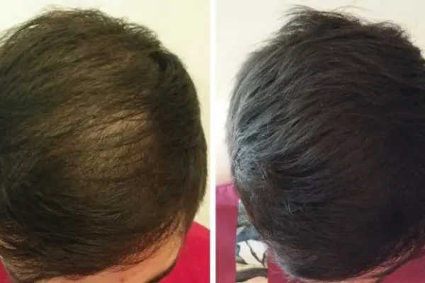 A che eta’ e’ consentito fare un trapianto di capelli?