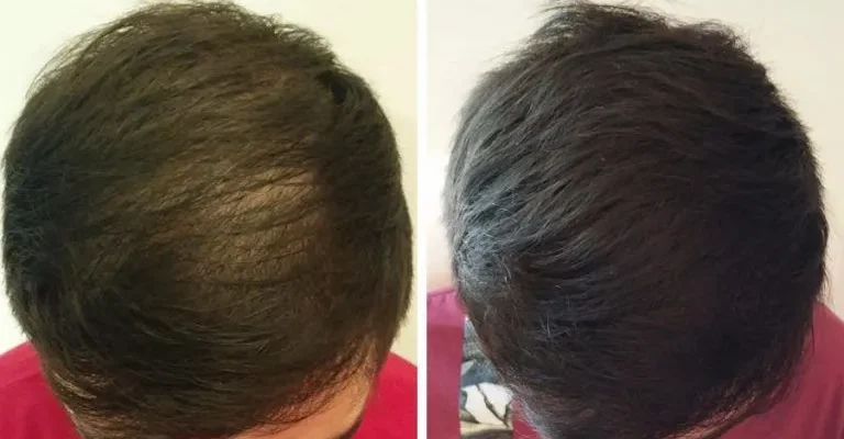A che eta’ e’ consentito fare un trapianto di capelli?