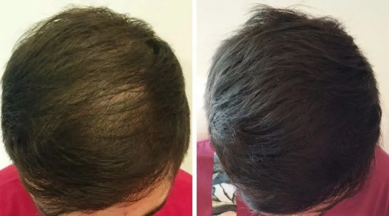 A che eta’ e’ consentito fare un trapianto di capelli?