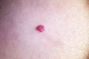 Angioma del cuoio capelluto: Cos’è e come rimuoverlo 3 Angioma del cuoio capelluto: Cos’è e come rimuoverlo