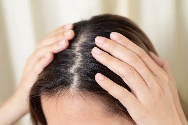 Cos’è il lievito di Malassezia? C’entra con i capelli?