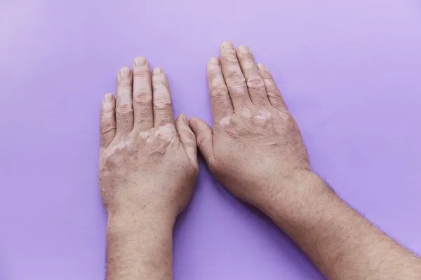 Caduta dei capelli da lupus, come si risolve? 1 Caduta dei capelli da lupus, come si risolve?