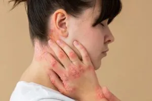 Psoriasi del cuoio capelluto: cause, sintomi e trattamenti 3 Psoriasi del cuoio capelluto: cause, sintomi e trattamenti