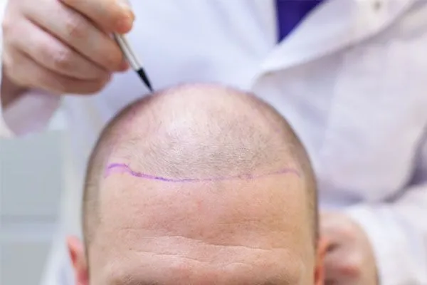 Esperienze Reali di Trapianto Capelli: Testimonianze, Risultati e Storie di Successo