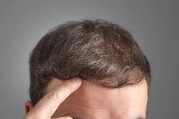 Domande frequenti e miti sul trapianto di capelli: la guida definitiva