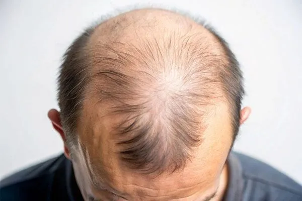 Malattie che causano l’alopecia 4 Malattie che causano l’alopecia