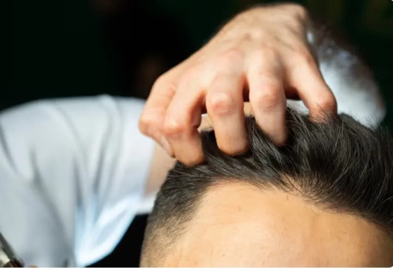 Greffe de cheveux : nombre de UF par zone à couvrir 6 Greffe de cheveux : nombre de UF par zone à couvrir