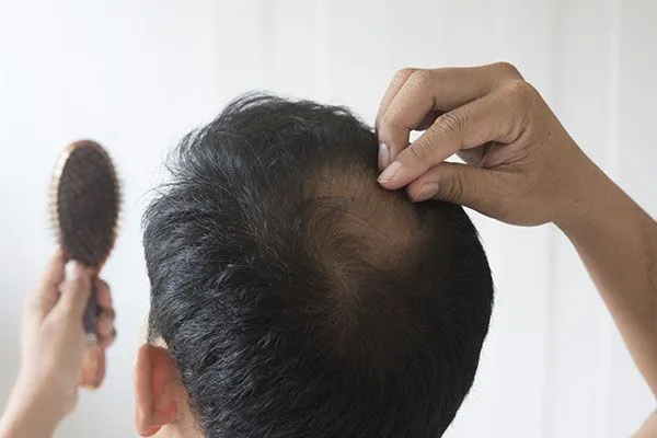 Quelle est la meilleure solution pour la calvitie? 6 Quelle est la meilleure solution pour la calvitie?