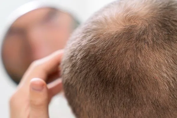 Cellule staminali per combattere l’alopecia 4 Cellule staminali per combattere l’alopecia