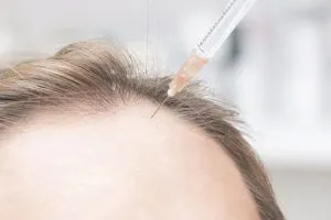 Trapianto di capelli senza radersi la testa: è possibile?
