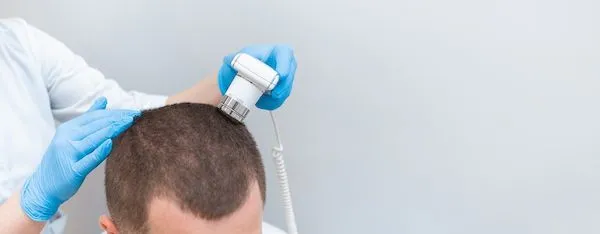 Si può fermare l’alopecia giovanile?