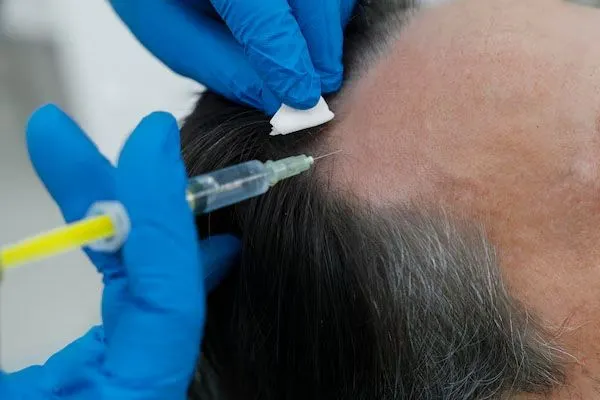 Cura dopo un trapianto di capelli: guida completa per un recupero di successo