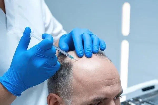 Gradi di alopecia