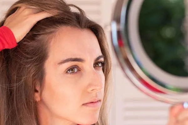 Alopecia androgenetica nelle giovani donne