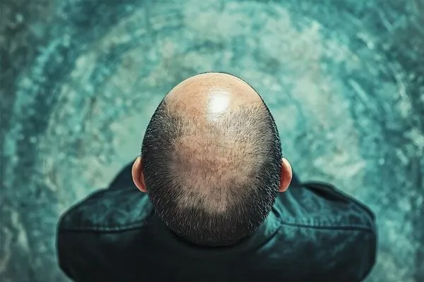 Inibitori JAK per l’Alopecia Areata: Cosa Sono e Quando si Usano 2 Inibitori JAK per l’Alopecia Areata: Cosa Sono e Quando si Usano