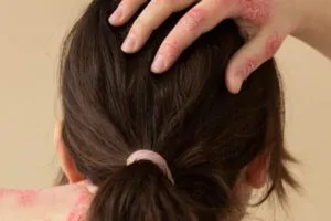 Alopecia seborroica: cause, sintomi e rimedi efficaci 2 Alopecia seborroica: cause, sintomi e rimedi efficaci