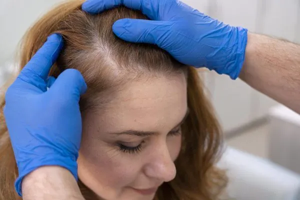 Trapianto capelli donna senza rasatura 2 Trapianto capelli donna senza rasatura